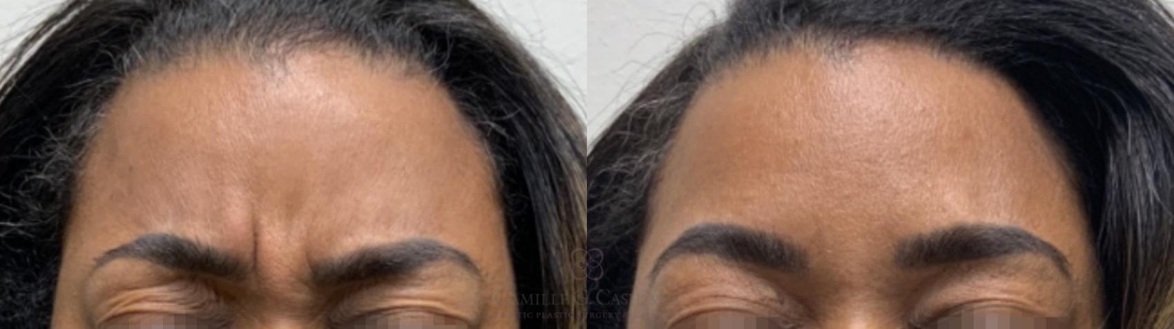 Before & After BOTOX® Cosmetic Case 585 Front View in Houston, TX