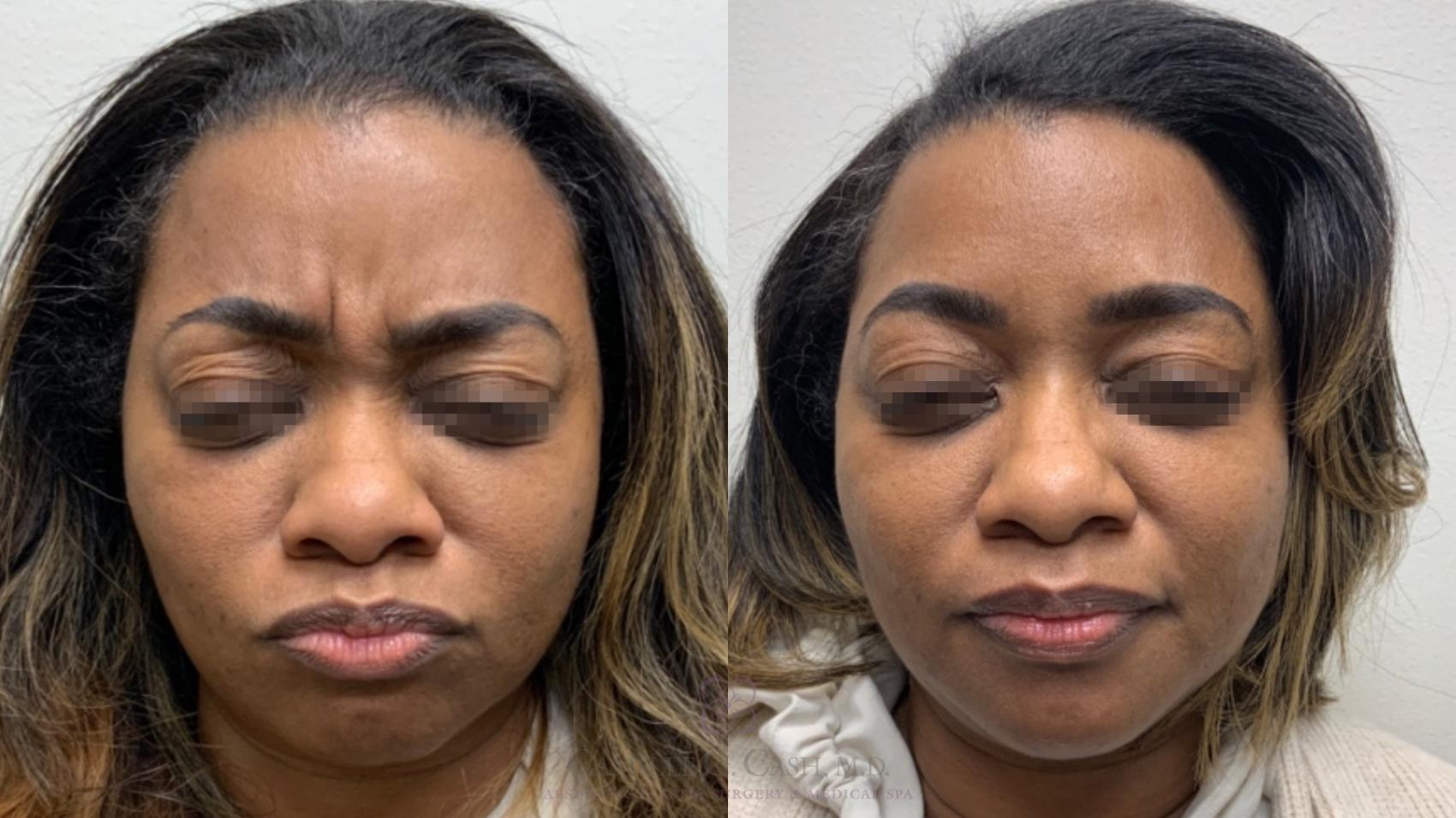 Before & After BOTOX® Cosmetic Case 585 front full View in Houston, TX
