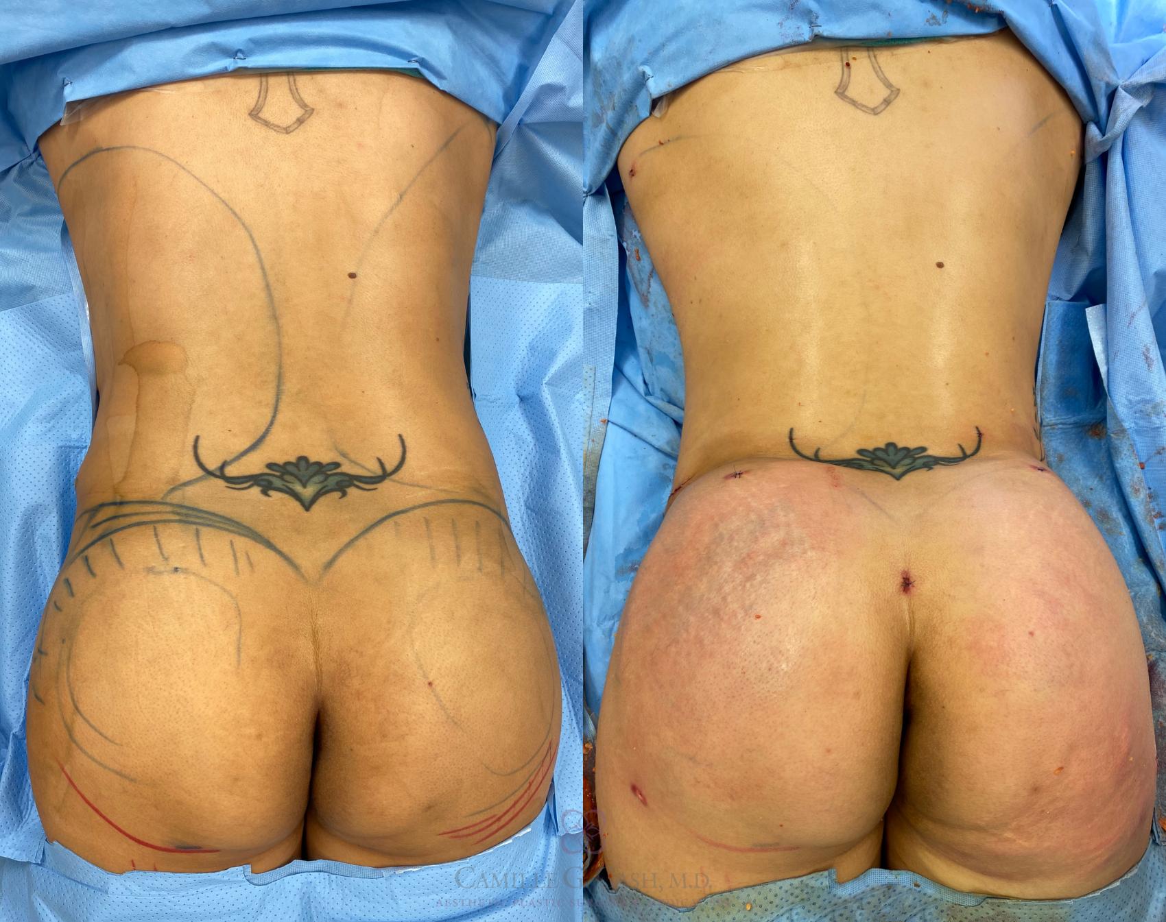 Before & After Brazilian Butt Lift Case 357 View #1 View in Houston, TX