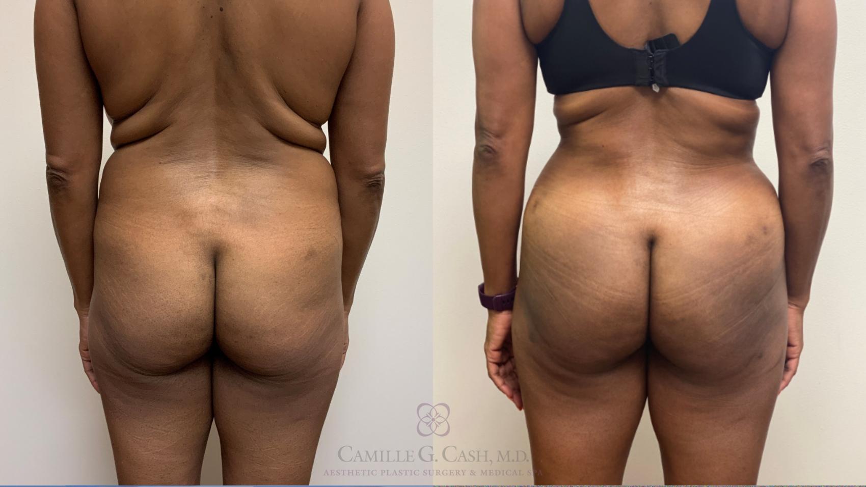 Before & After Brazilian Butt Lift Case 522 Back View in Houston, TX