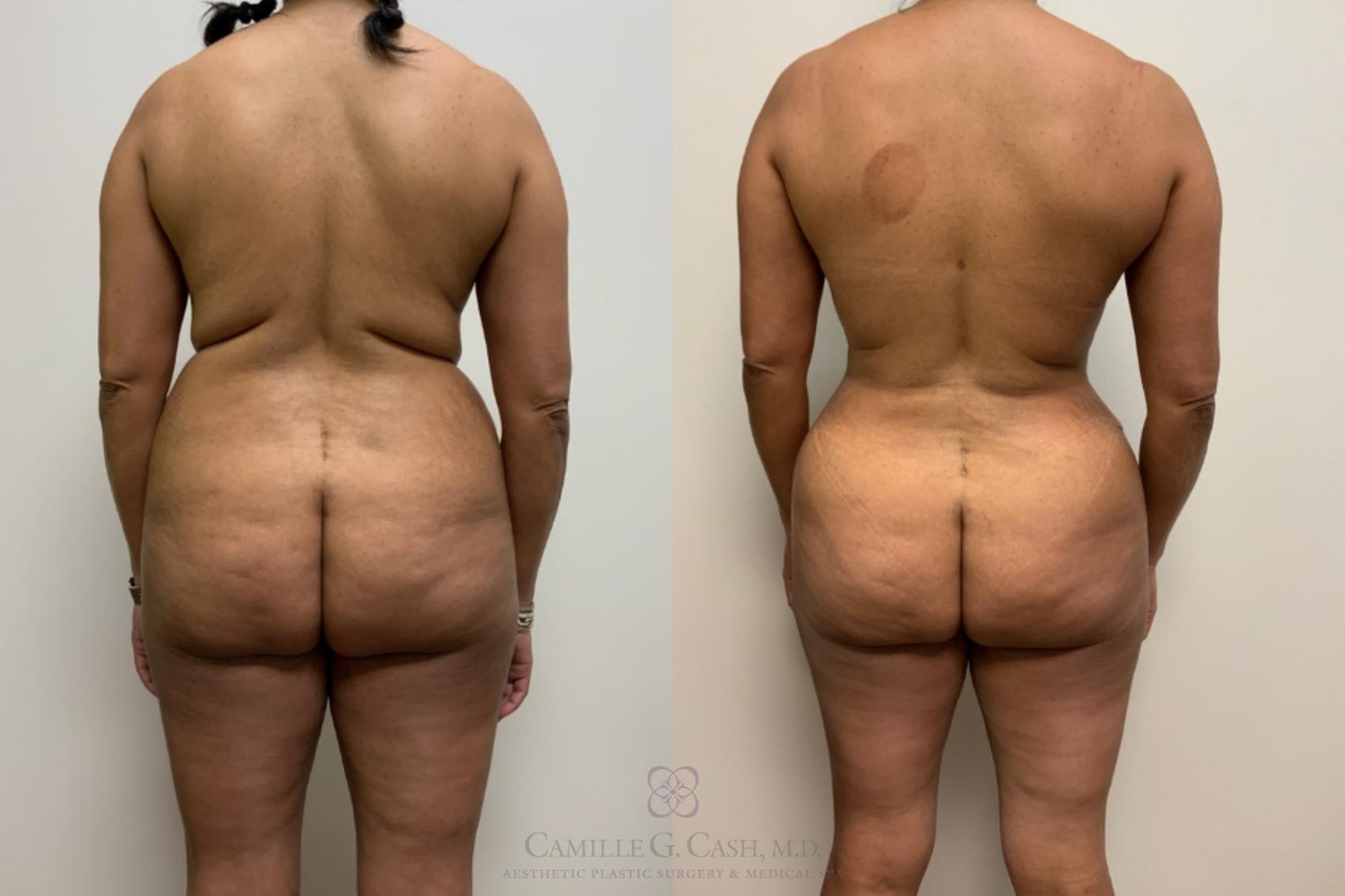 Before & After Brazilian Butt Lift Case 554 Back View in Houston, TX