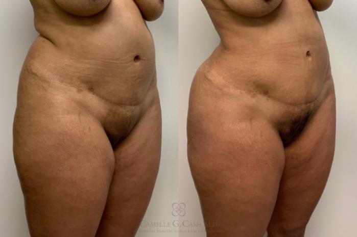 Before & After Brazilian Butt Lift Case 554 Left Oblique View in Houston, TX