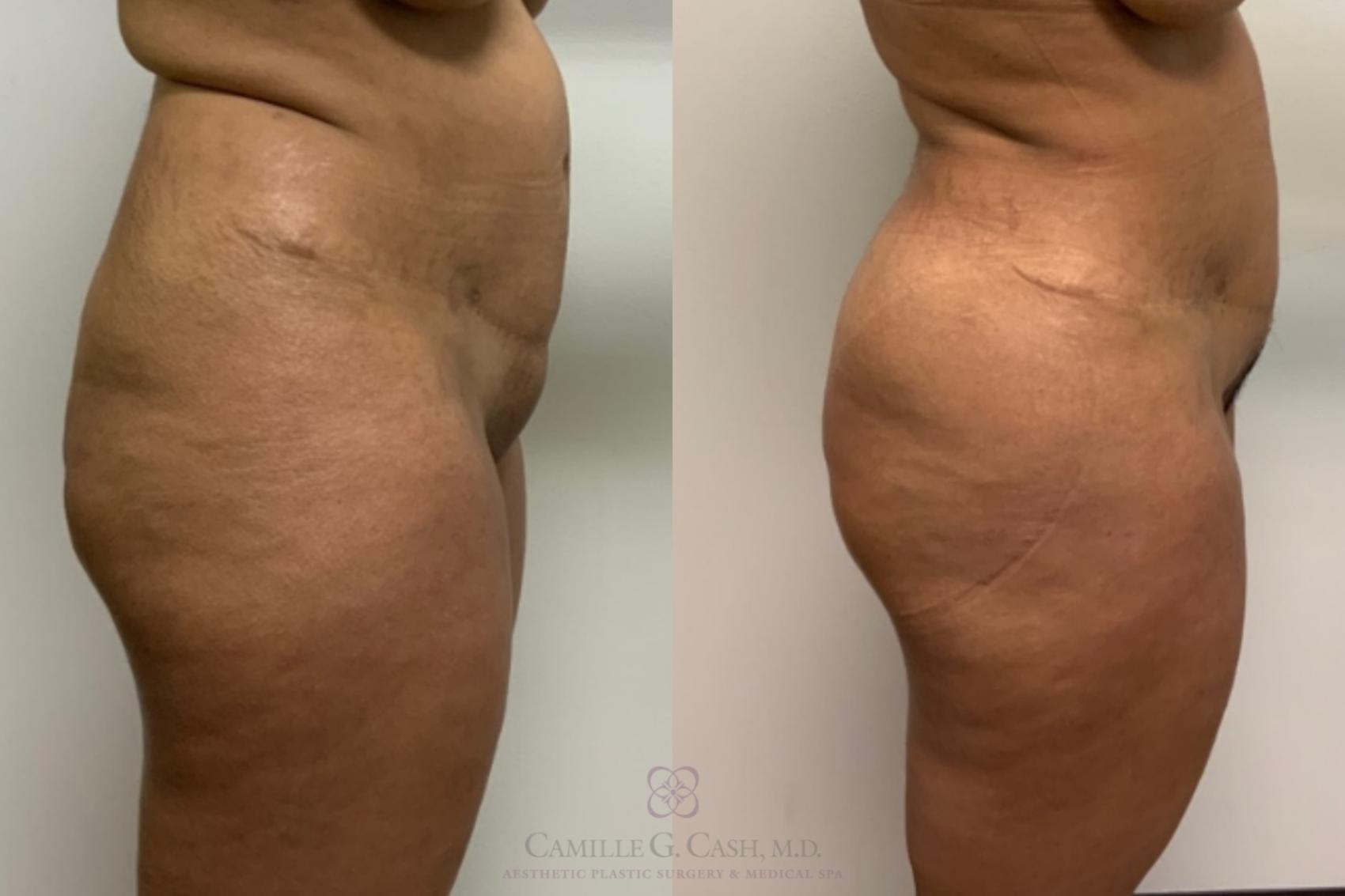 Before & After Brazilian Butt Lift Case 554 Left Side View in Houston, TX