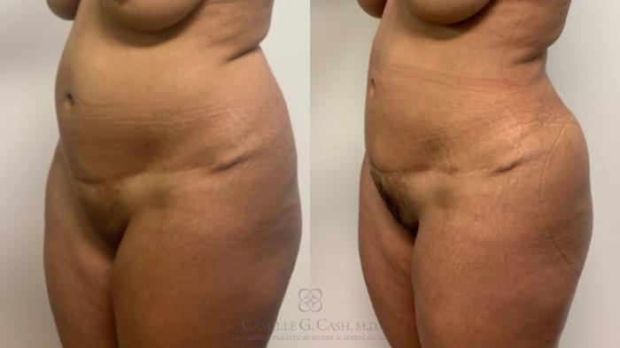 Before & After Brazilian Butt Lift Case 554 Right Oblique View in Houston, TX