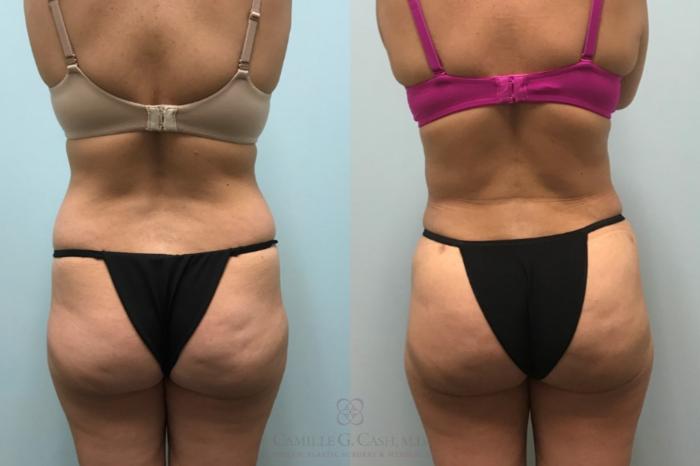 Before & After Brazilian Butt Lift Case 596 Back View in Houston, TX