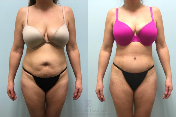 Before & After Brazilian Butt Lift Case 596 Front View in Houston, TX