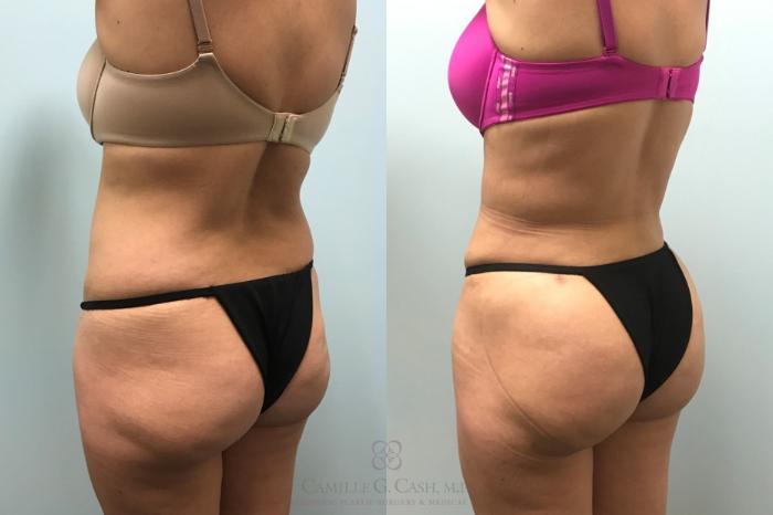 Before & After Brazilian Butt Lift Case 596 Left Oblique View in Houston, TX