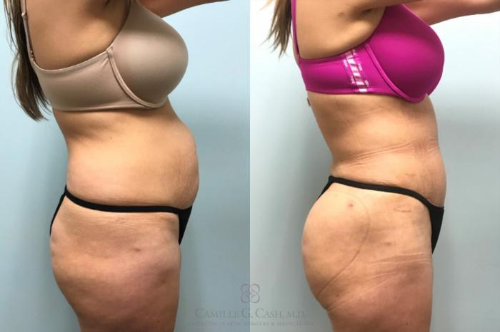 Before & After Brazilian Butt Lift Case 596 Left Side View in Houston, TX