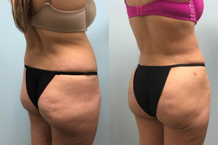 Before & After Brazilian Butt Lift Case 596 Right Oblique View in Houston, TX