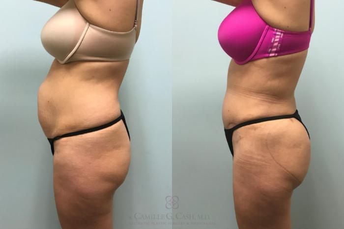Before & After Brazilian Butt Lift Case 596 Right Side View in Houston, TX