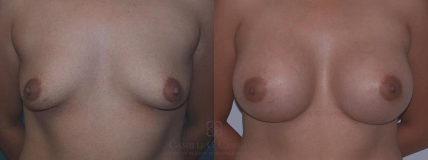 Before & After Breast Augmentation Case 1 View #1 View in Houston, TX