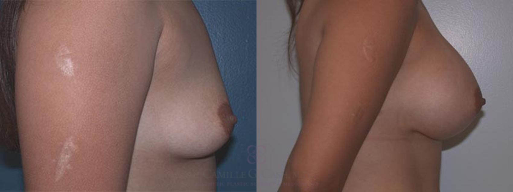 Before & After Breast Augmentation Case 1 View #2 View in Houston, TX