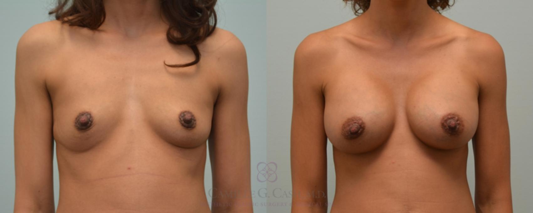 Before & After Breast Augmentation Case 107 View #1 View in Houston, TX
