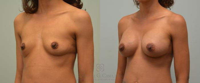 Before & After Breast Augmentation Case 107 View #2 View in Houston, TX