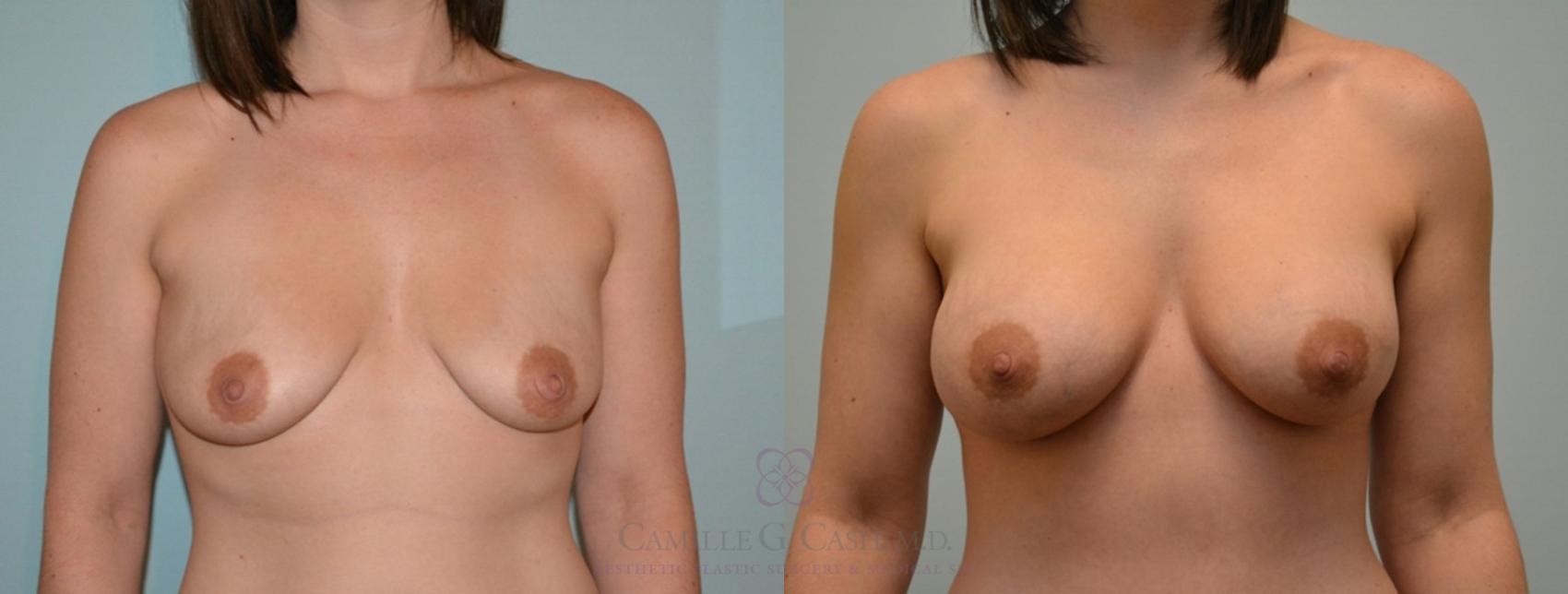 Before & After Breast Augmentation Case 109 View #1 View in Houston, TX