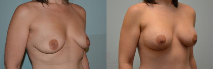 Before & After Breast Augmentation Case 109 View #2 View in Houston, TX