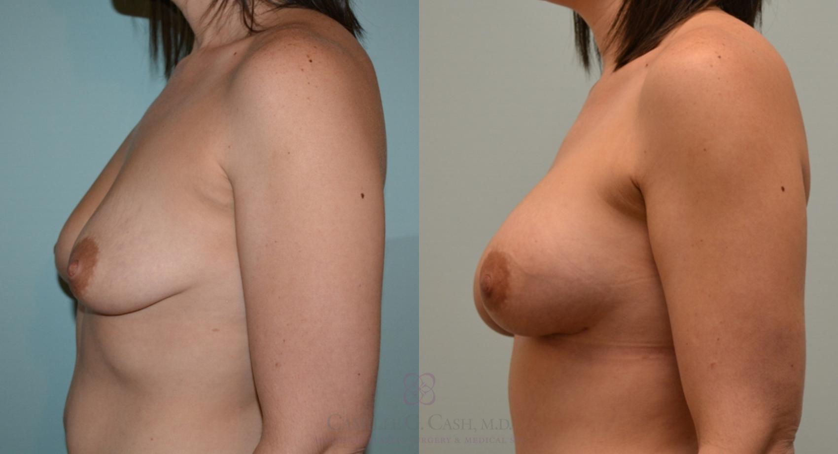 Before & After Breast Augmentation Case 109 View #3 View in Houston, TX