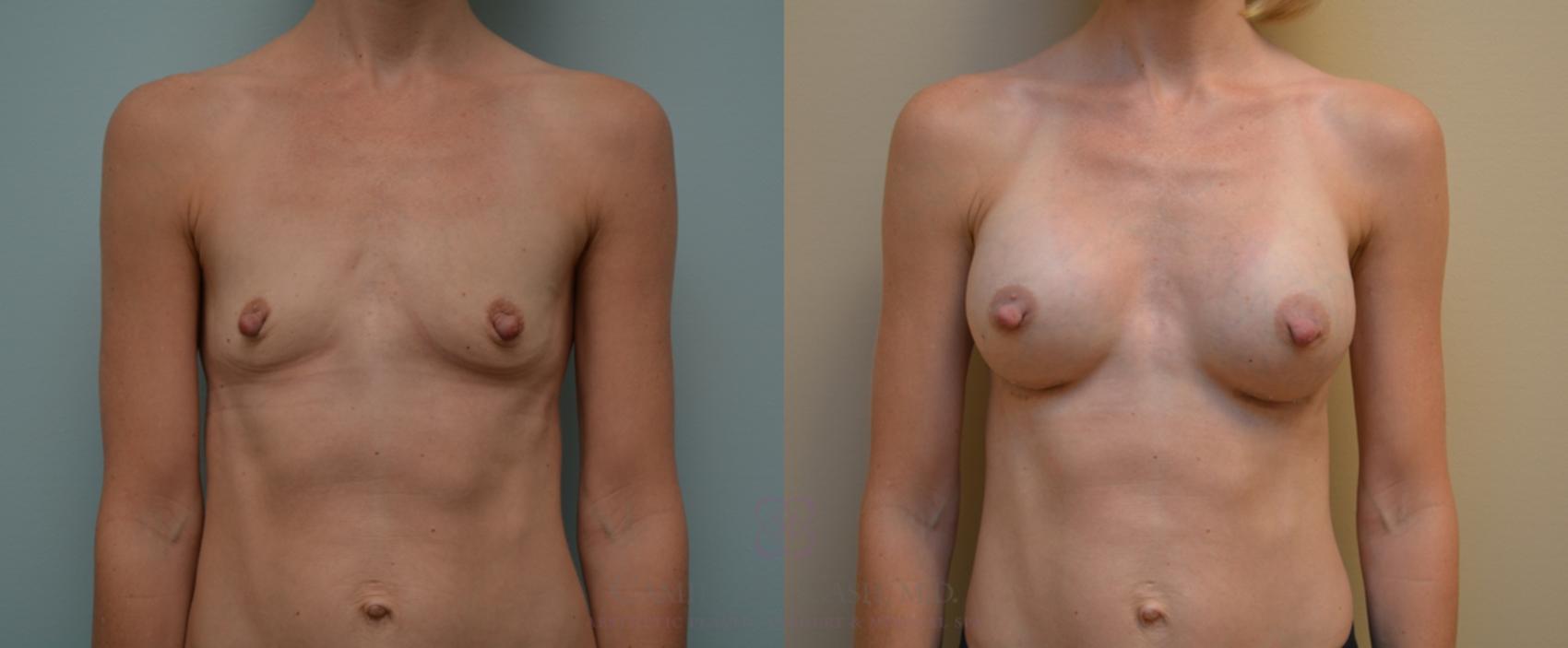 Before & After Breast Augmentation Case 110 View #1 View in Houston, TX