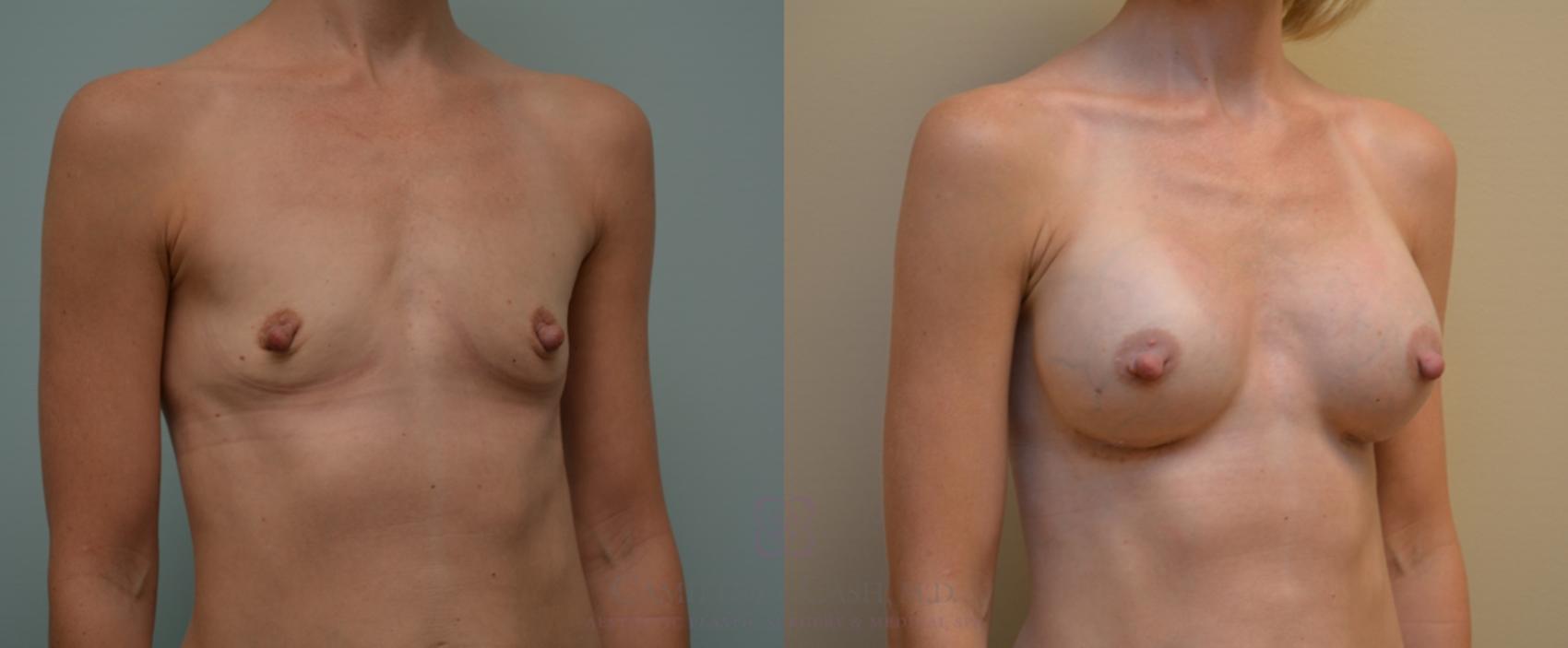 Before & After Breast Augmentation Case 110 View #2 View in Houston, TX