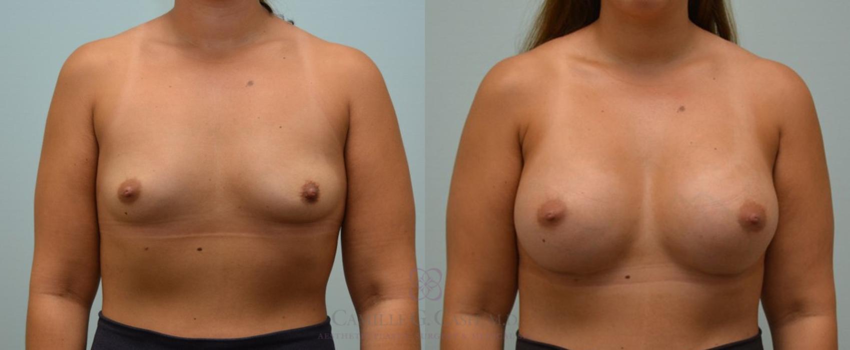 Before & After Breast Augmentation Case 114 View #1 View in Houston, TX