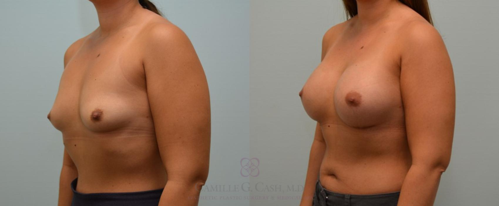 Before & After Breast Augmentation Case 114 View #2 View in Houston, TX