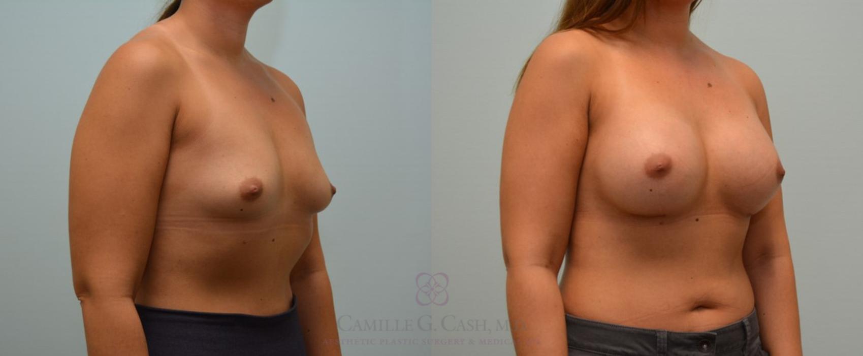 Before & After Breast Augmentation Case 114 View #3 View in Houston, TX