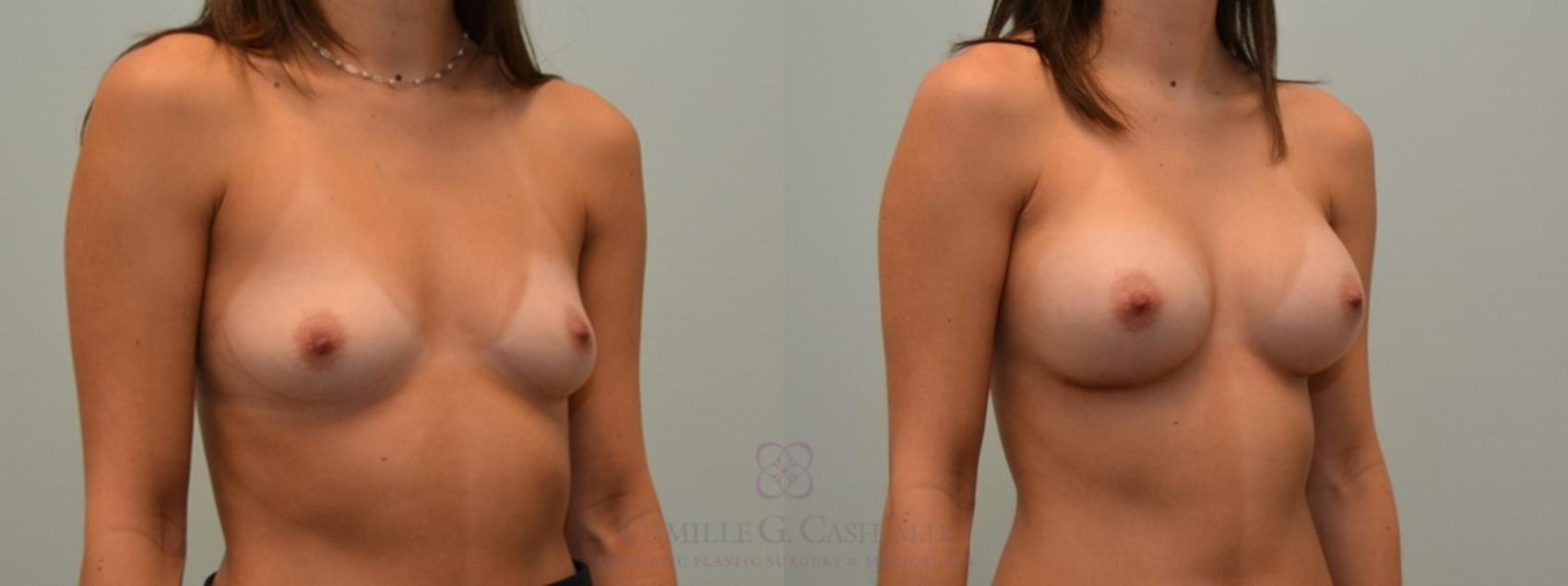Before & After Breast Augmentation Case 115 View #2 View in Houston, TX
