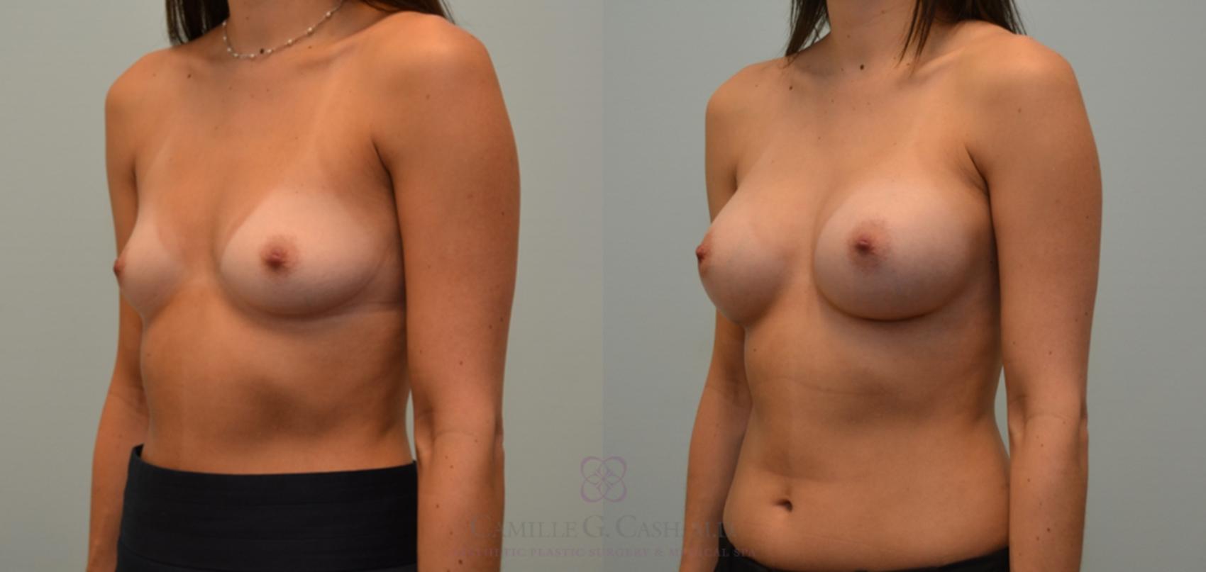 Before & After Breast Augmentation Case 115 View #3 View in Houston, TX