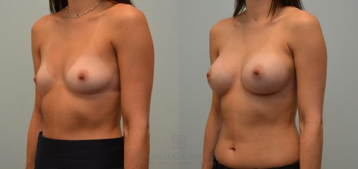Before & After Breast Augmentation Case 115 View #3 View in Houston, TX