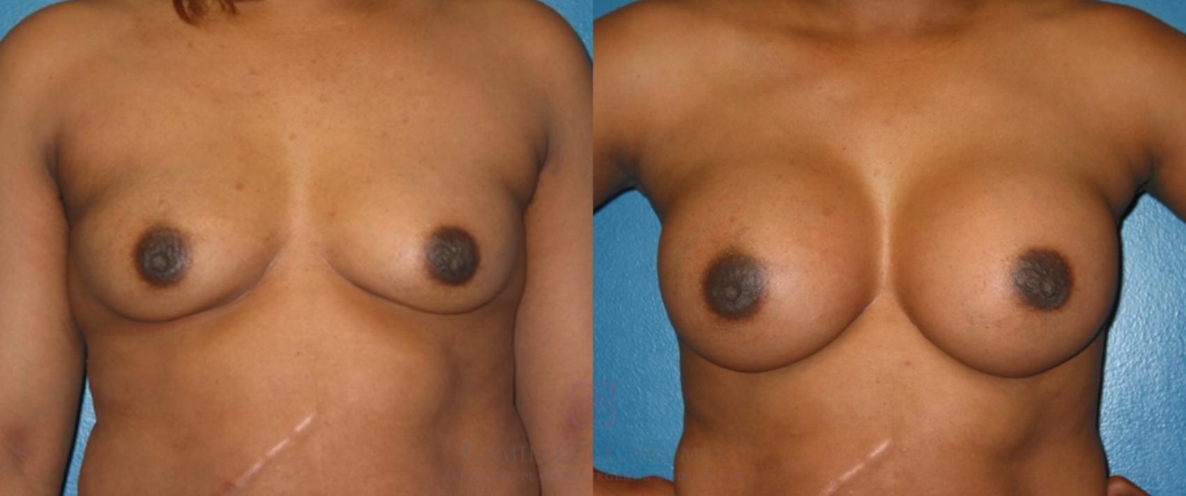 Before & After Breast Augmentation Case 120 View #1 View in Houston, TX