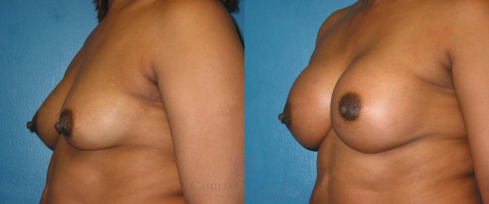 Before & After Breast Augmentation Case 120 View #2 View in Houston, TX