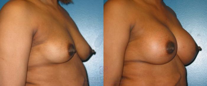 Before & After Breast Augmentation Case 120 View #3 View in Houston, TX