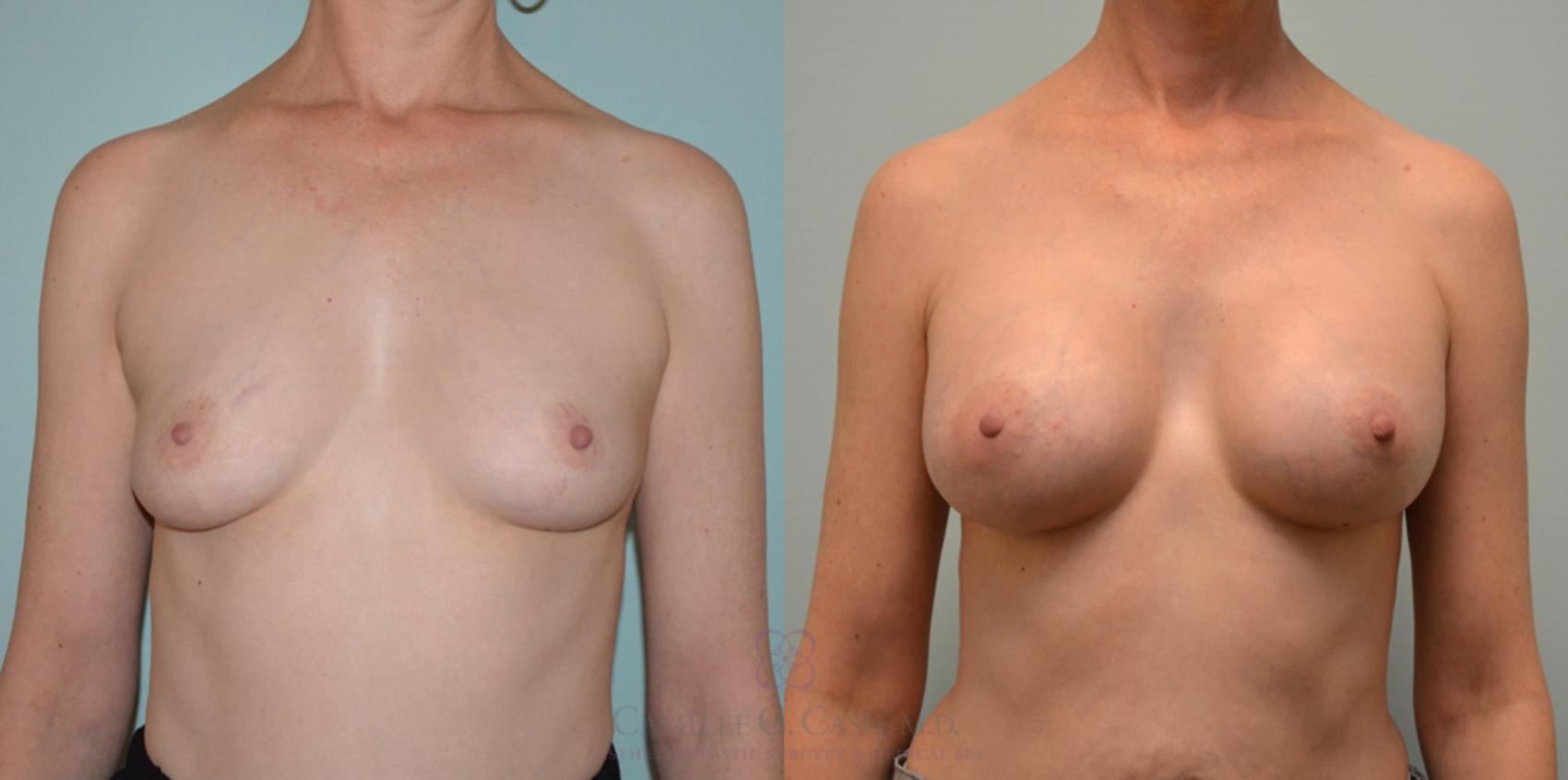 Before & After Breast Augmentation Case 123 View #1 View in Houston, TX