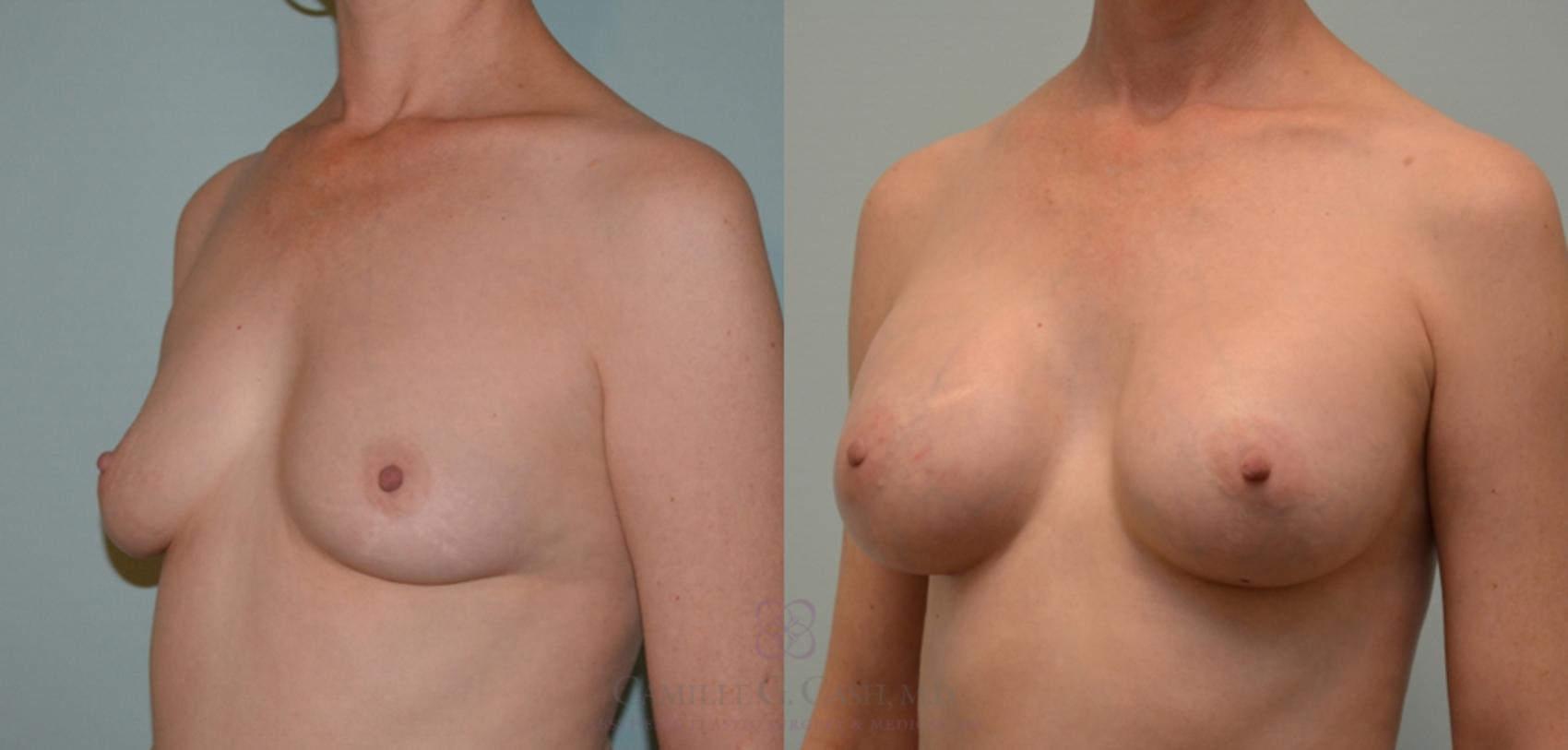 Before & After Breast Augmentation Case 123 View #2 View in Houston, TX