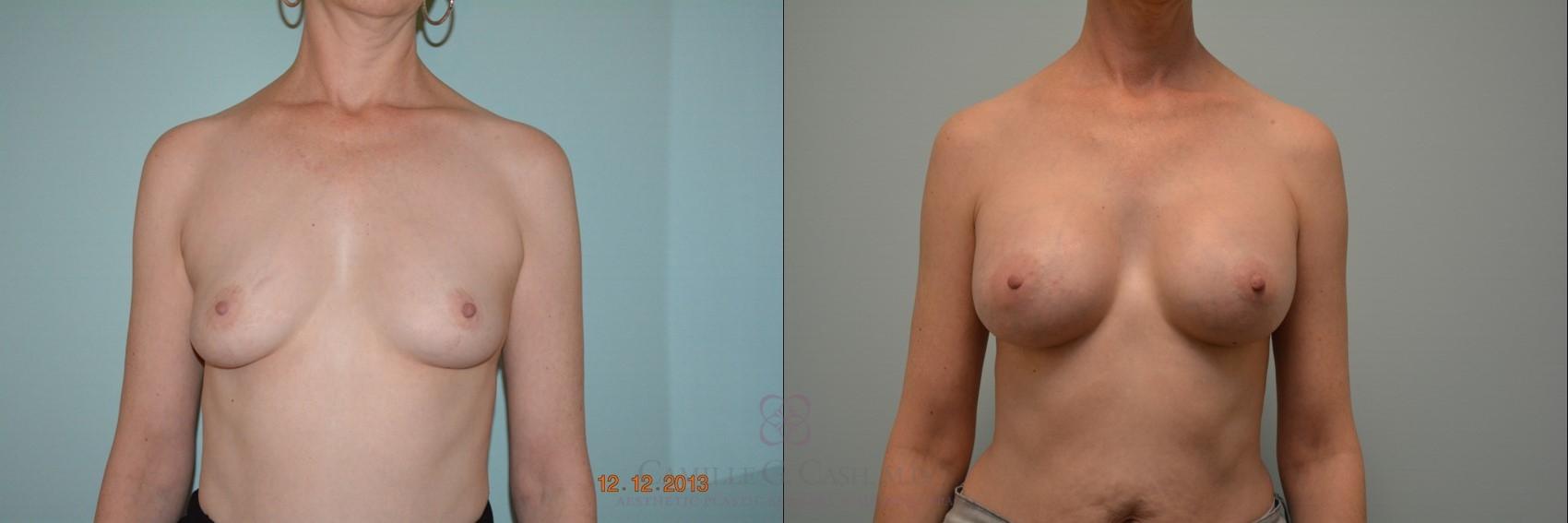 Before & After Breast Augmentation Case 123 View #3 View in Houston, TX