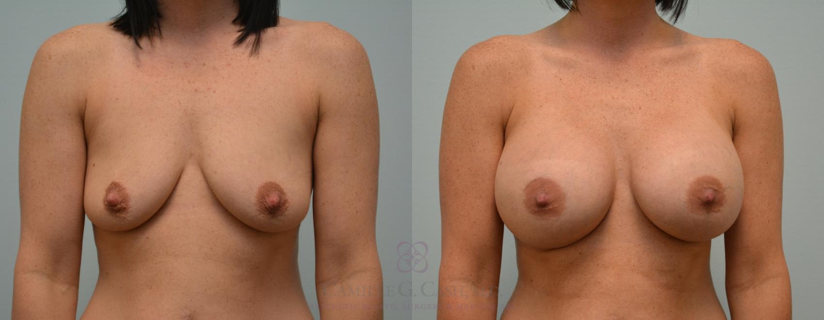 Before & After Breast Augmentation Case 124 View #1 View in Houston, TX