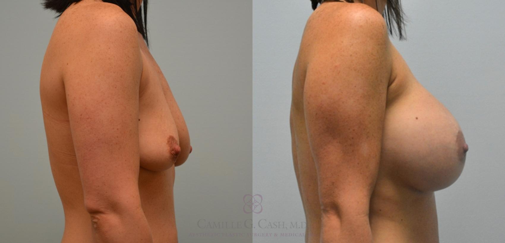 Before & After Breast Augmentation Case 124 View #2 View in Houston, TX