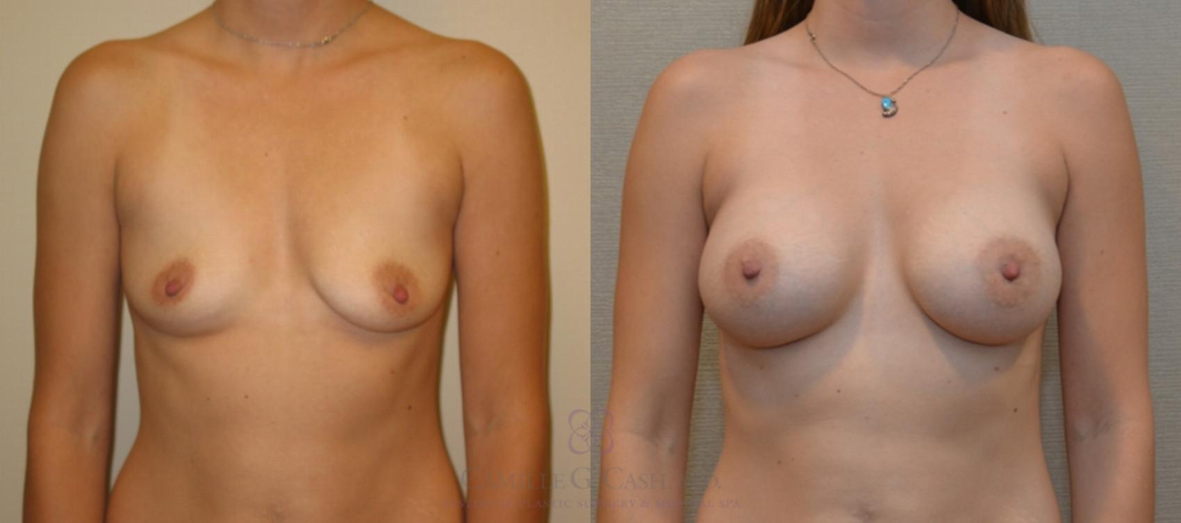 Before & After Breast Augmentation Case 132 View #1 View in Houston, TX