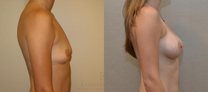 Before & After Breast Augmentation Case 132 View #3 View in Houston, TX