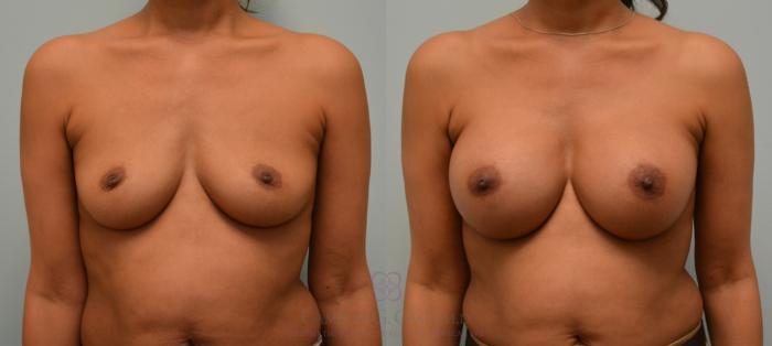 Before & After Breast Augmentation Case 139 View #1 View in Houston, TX