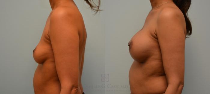 Before & After Breast Augmentation Case 139 View #2 View in Houston, TX
