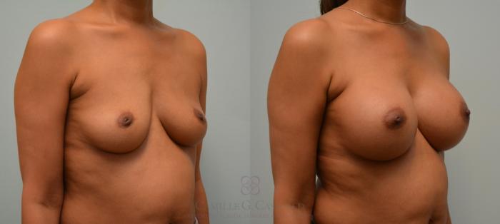 Before & After Breast Augmentation Case 139 View #3 View in Houston, TX