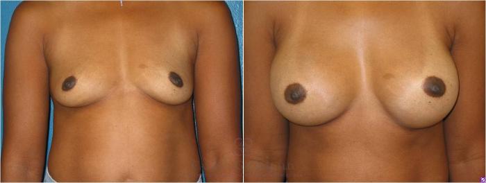 Before & After Breast Augmentation Case 14 View #1 View in Houston, TX