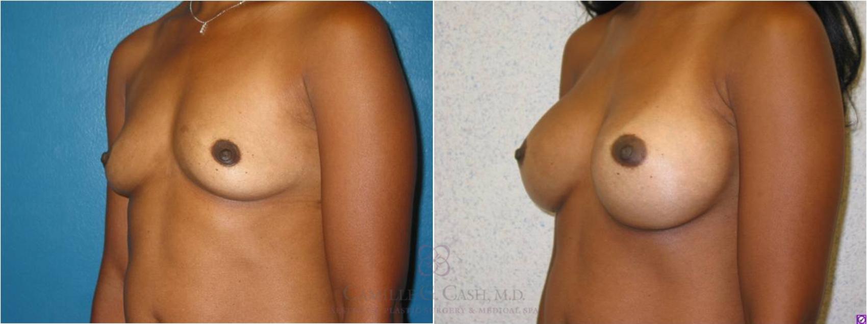 Before & After Breast Augmentation Case 14 View #2 View in Houston, TX