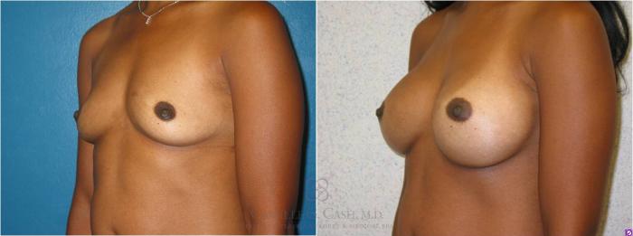 Before & After Breast Augmentation Case 14 View #2 View in Houston, TX
