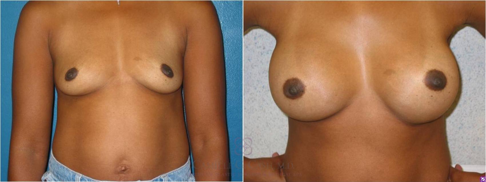 Before & After Breast Augmentation Case 14 View #3 View in Houston, TX