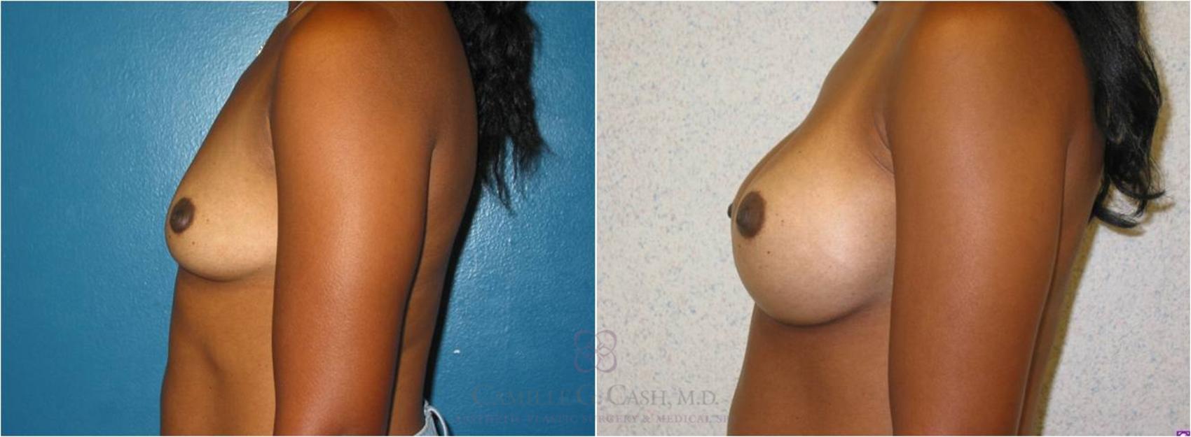 Before & After Breast Augmentation Case 14 View #4 View in Houston, TX