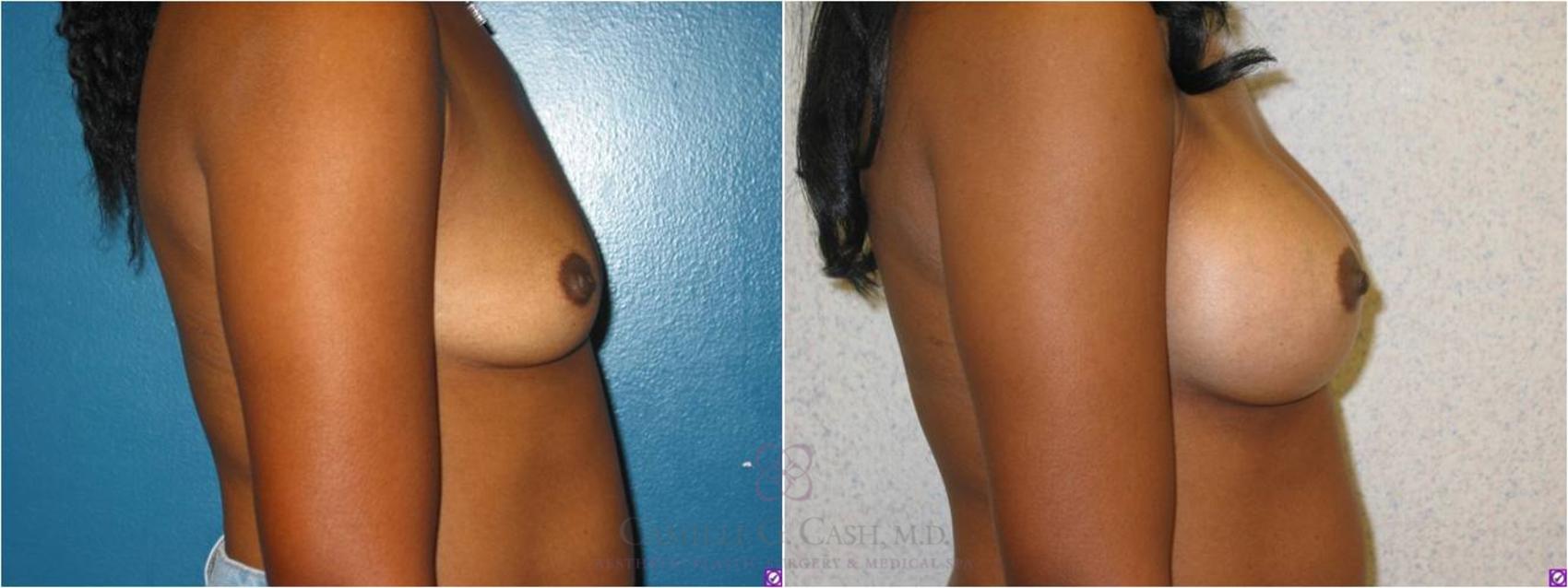 Before & After Breast Augmentation Case 14 View #5 View in Houston, TX