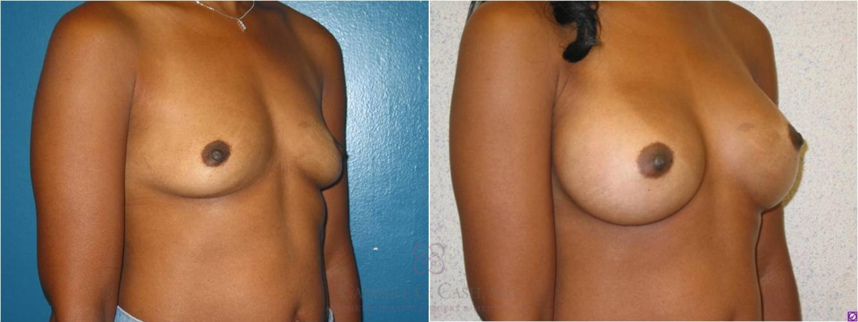 Before & After Breast Augmentation Case 14 View #6 View in Houston, TX