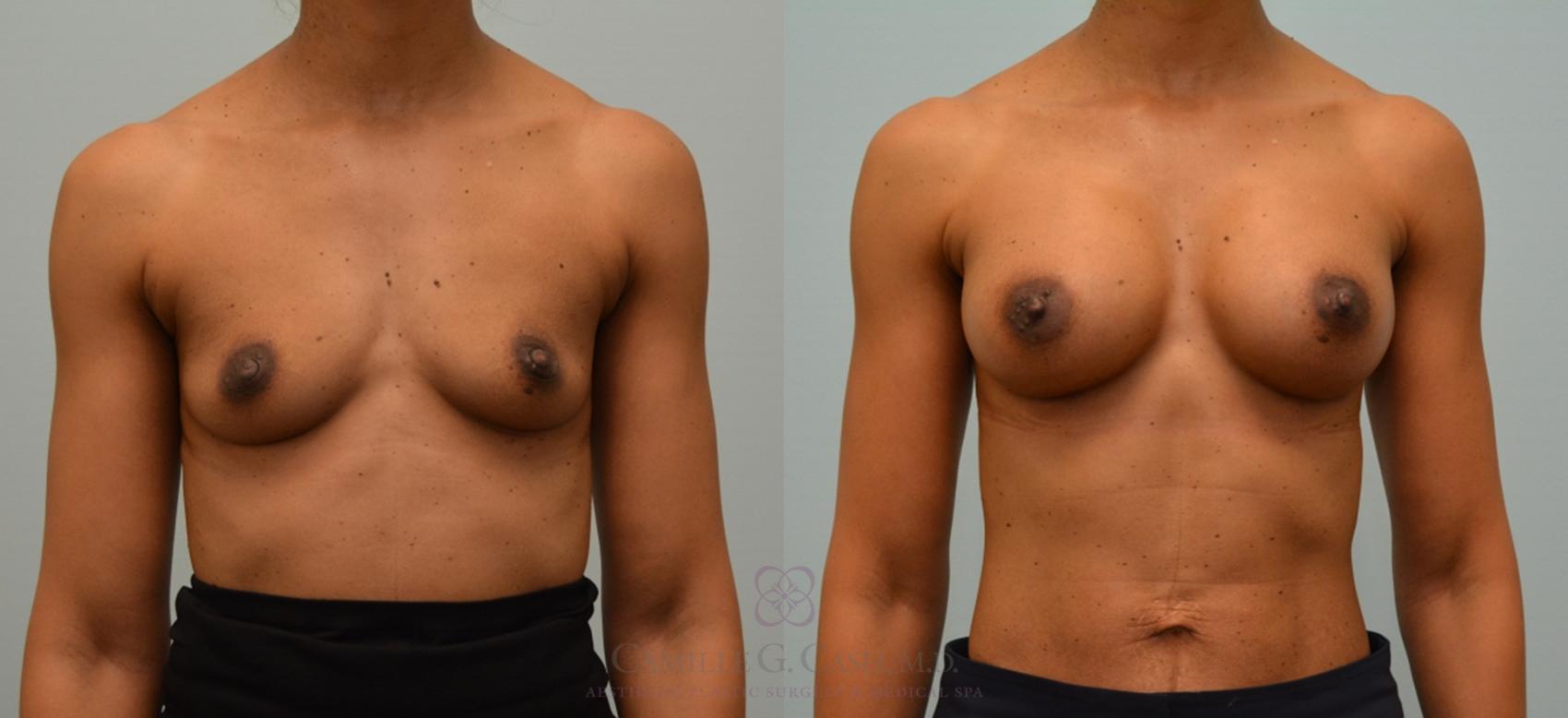 Before & After Breast Augmentation Case 149 View #1 View in Houston, TX
